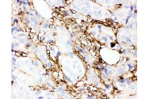 Anti-Annexin V Picoband antibody,  IHC(P): Human Mammary Cancer Tissue
