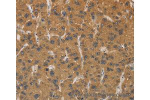 Immunohistochemistry of Human gastric cancer using CYP17A1 Polyclonal Antibody at dilution of 1:30 (CYP17A1 抗体)