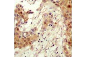 Immunohistochemical analysis of AKT2 (pS474) staining in human breast cancer formalin fixed paraffin embedded tissue section. (AKT2 抗体  (C-Term, pSer474))