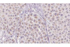 ABIN6276733 at 1/100 staining Human melanoma tissue by IHC-P. (SERPINC1 抗体  (Internal Region))