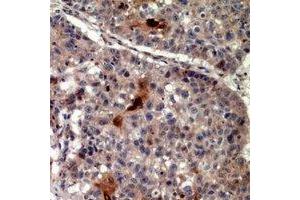 Immunohistochemical analysis of TRIF staining in human lung cancer formalin fixed paraffin embedded tissue section. (TICAM1 抗体  (C-Term))