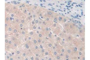 IHC-P analysis of Human Liver cancer Tissue, with DAB staining. (GALC 抗体  (AA 375-535))