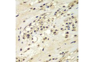Immunohistochemistry of paraffin-embedded human kidney cancer using CHEK1 antibody. (CHEK1 抗体)