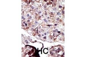 Formalin-fixed and paraffin-embedded human cancer tissue reacted with the primary antibody, which was peroxidase-conjugated to the secondary antibody, followed by AEC staining. (SPHK2 抗体  (N-Term))