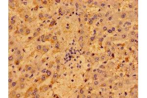 Immunohistochemistry of paraffin-embedded human liver cancer using ABIN7162453 at dilution of 1:100 (P2RY1 抗体  (AA 329-373))