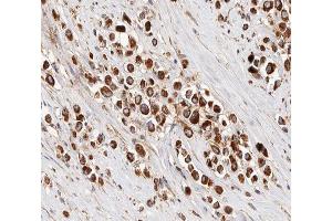 ABIN6266856 at 1/100 staining human Breast cancer tissue sections by IHC-P. (IRX2 抗体  (Internal Region))