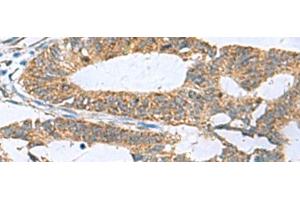 Immunohistochemistry of paraffin-embedded Human colorectal cancer tissue using HPCAL1 Polyclonal Antibody at dilution of 1:70(x200) (HPCAL1 抗体)