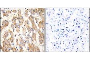 Immunohistochemistry analysis of paraffin-embedded human liver carcinoma, using BAX Antibody. (BAX 抗体  (AA 41-90))