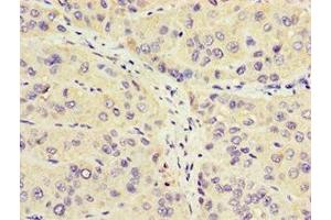 Immunohistochemistry of paraffin-embedded human liver cancer using ABIN7162964 at dilution of 1:100 (CROT 抗体  (AA 1-87))