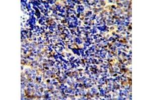 IHC analysis of FFPE human lymphoma stained with MERTK antibody (MERTK 抗体)