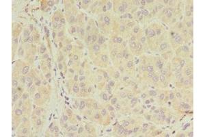 Immunohistochemistry of paraffin-embedded human liver cancer using ABIN7155026 at dilution of 1:100