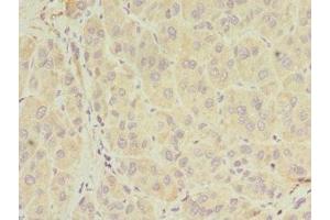 Immunohistochemistry of paraffin-embedded human liver cancer using ABIN7155026 at dilution of 1:100 (SERPIND1 抗体  (AA 20-290))