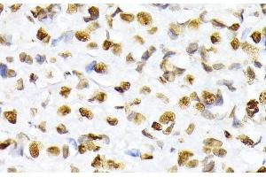 Immunohistochemistry of paraffin-embedded Human breast cancer using Phospho-Histone H2A(S129) Polyclonal Antibody at dilution of 1:100 (40x lens). (Histone H2A 抗体  (pSer129))