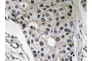 Immunohistochemistry analyzes of Ob antibody in paraffin-embedded human breast carcinoma tissue. (Leptin 抗体)