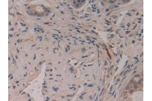 Detection of GAP43 in Human Pancreatic cancer Tissue using Polyclonal Antibody to Growth Associated Protein 43 (GAP43) (GAP43 抗体  (AA 1-274))