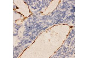 Anti-CD31 Picoband antibody,  IHC(P): Human Lung Cancer Tissue