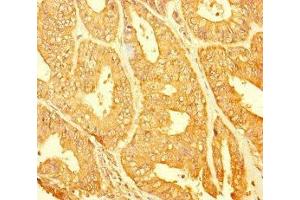 Immunohistochemistry of paraffin-embedded human endometrial cancer using ABIN7147689 at dilution of 1:100 (CHTOP 抗体  (AA 179-248))