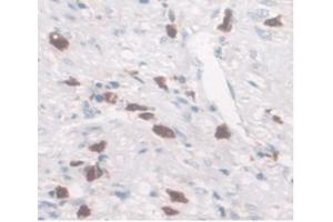 DAB staining on IHC-P Samples:Human Rectum Cancer Tissue. (SLC40A1 抗体  (AA 127-321))