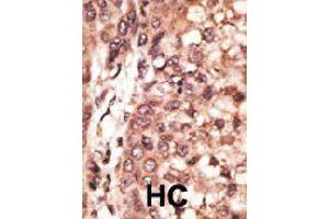 Formalin-fixed and paraffin-embedded human hepatocellular carcinoma tissue reacted with CREB3L1 polyclonal antibody  , which was peroxidase-conjugated to the secondary antibody, followed by DAB staining. (CREB3L1 抗体  (C-Term))