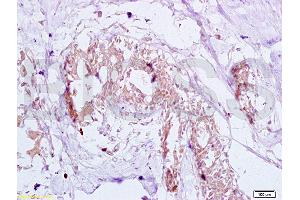 Formalin-fixed and human breast carcinoma tissue labeled with Anti-GTPBP10 Polyclonal Antibody (ABIN750748), Unconjugated at 1:200 followed by conjugation to the secondary antibody and DAB staining (GTPBP10 抗体  (AA 151-250))
