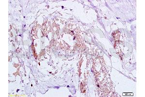 Formalin-fixed and human breast carcinoma tissue labeled with Anti-GTPBP10 Polyclonal Antibody (ABIN750748), Unconjugated at 1:200 followed by conjugation to the secondary antibody and DAB staining