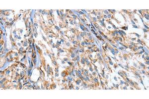 Immunohistochemistry of paraffin-embedded Human esophagus cancer using APOBEC3D Polyclonal Antibody at dilution of 1:80 (APOBEC3D 抗体)