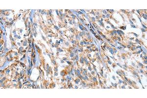 Immunohistochemistry of paraffin-embedded Human esophagus cancer using APOBEC3D Polyclonal Antibody at dilution of 1:80 (APOBEC3D 抗体)