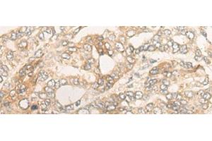 Immunohistochemistry of paraffin-embedded Human liver cancer tissue using DUOX2 Polyclonal Antibody at dilution of 1:40(x200) (DUOX2 抗体)