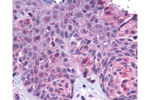 Anti-GPR162 antibody IHC of human Skin, Melanoma. (GPR162 抗体  (Extracellular Domain))