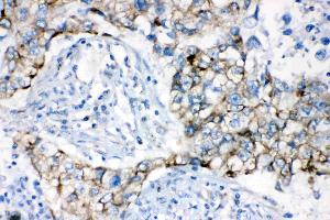 AK2 was detected in paraffin-embedded sections of human lung cancer tissues using rabbit anti- AK2 Antigen Affinity purified polyclonal antibody (Catalog # ) at 1 µg/mL. (Adenylate Kinase 2 抗体  (AA 161-239))
