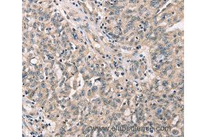 Immunohistochemistry of Human cervical cancer using CDK12 Polyclonal Antibody at dilution of 1:30 (CDK12 抗体)