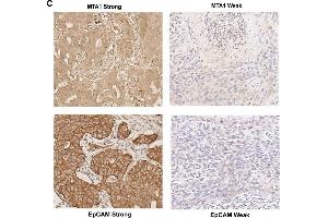 Expression of MTA1 and EpCAM in tissue microarray samples.
