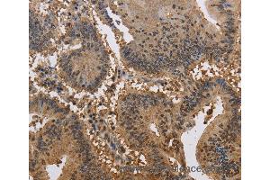 Immunohistochemistry of Human liver cancer using JAG2 Polyclonal Antibody at dilution of 1:30 (JAG2 抗体)