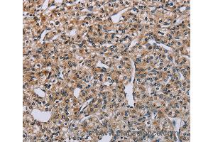 Immunohistochemistry of Human lung cancer using PNPT1 Polyclonal Antibody at dilution of 1:40 (PNPT1 抗体)