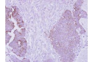 IHC-P Image Immunohistochemical analysis of paraffin-embedded human colon carcinoma, using Arginase II, antibody at 1:250 dilution. (ARG2 抗体  (Center))