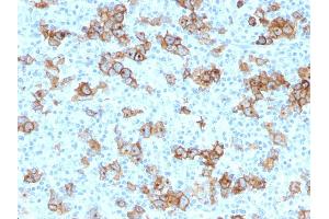Formalin-fixed, paraffin-embedded human Hodgkin's Lymphoma stained with CD30 Monoclonal Antibody (Ki-1/779). (TNFRSF8 抗体)