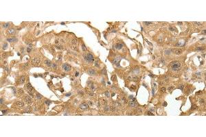 Immunohistochemistry of paraffin-embedded Human lung cancer using TXN Polyclonal Antibody at dilution of 1:40 (TXN 抗体)