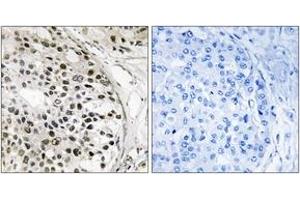 Immunohistochemistry analysis of paraffin-embedded human breast carcinoma tissue, using MNK1 (Ab-250) Antibody. (MKNK1 抗体  (AA 216-265))
