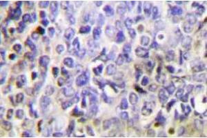 Immunohistochemistry analysis of Granzyme K in paraffin-embedded human lung carcinoma tissue. (GZMK 抗体)