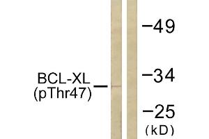 Immunohistochemistry analysis of paraffin-embedded human lung carcinoma tissue using BCL-XL (Phospho-Thr47) antibody. (BCL2L1 抗体  (pThr47))