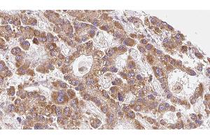 ABIN6279547 at 1/100 staining Human liver cancer tissue by IHC-P. (SLC16A6 抗体)