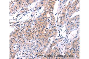 Immunohistochemistry of Human gastic cancer using VWF Polyclonal Antibody at dilution of 1:50 (VWF 抗体)