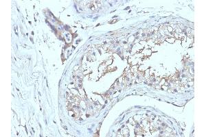 Formalin-fixed, paraffin-embedded human Testicular Ca stained with CD63 Monoclonal Antibody (NKI/C3 + LAMP3/968) (CD63 抗体)