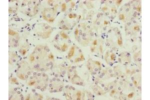 Immunohistochemistry of paraffin-embedded human gastric cancer using ABIN7158732 at dilution of 1:100 (LYSMD1 抗体  (AA 1-227))