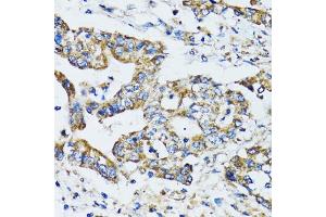 Immunohistochemistry of paraffin-embedded human colon carcinoma using ATG7 antibody (ABIN6292614) at dilution of 1:100 (40x lens). (ATG7 抗体)