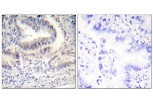 Immunohistochemical analysis of paraffin-embedded human lung carcinoma tissue using Lamin A (Cleaved-Asp230) Antibody (ABIN5978456). (Lamin A/C 抗体  (Cleaved-Asp230, Internal Region))