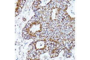 Immunohistochemistry of paraffin-embedded human Colon cancer using C2 Rabbit pAb (ABIN7265549) at dilution of 1:100 (40x lens). (AKR1C2 抗体  (AA 1-323))