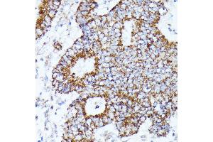 Immunohistochemistry of paraffin-embedded human Colon cancer using C2 Rabbit pAb (ABIN7265549) at dilution of 1:100 (40x lens).