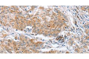 Immunohistochemistry of paraffin-embedded Human gastric cancer using CRELD2 Polyclonal Antibody at dilution of 1:50 (CRELD2 抗体)