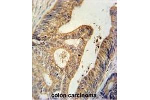 BTG1 Antibody (Center) (ABIN651304 and ABIN2840179) immunohistochemistry analysis in formalin fixed and paraffin embedded human colon carcinoma followed by peroxidase conjugation of the secondary antibody and DAB staining. (BTG1 抗体  (AA 92-118))